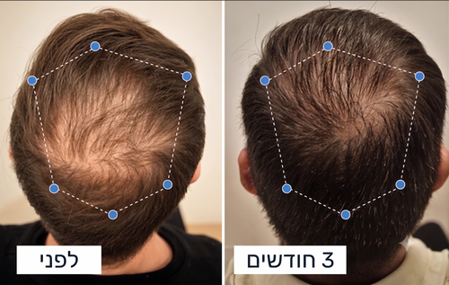 לפני ואחרי