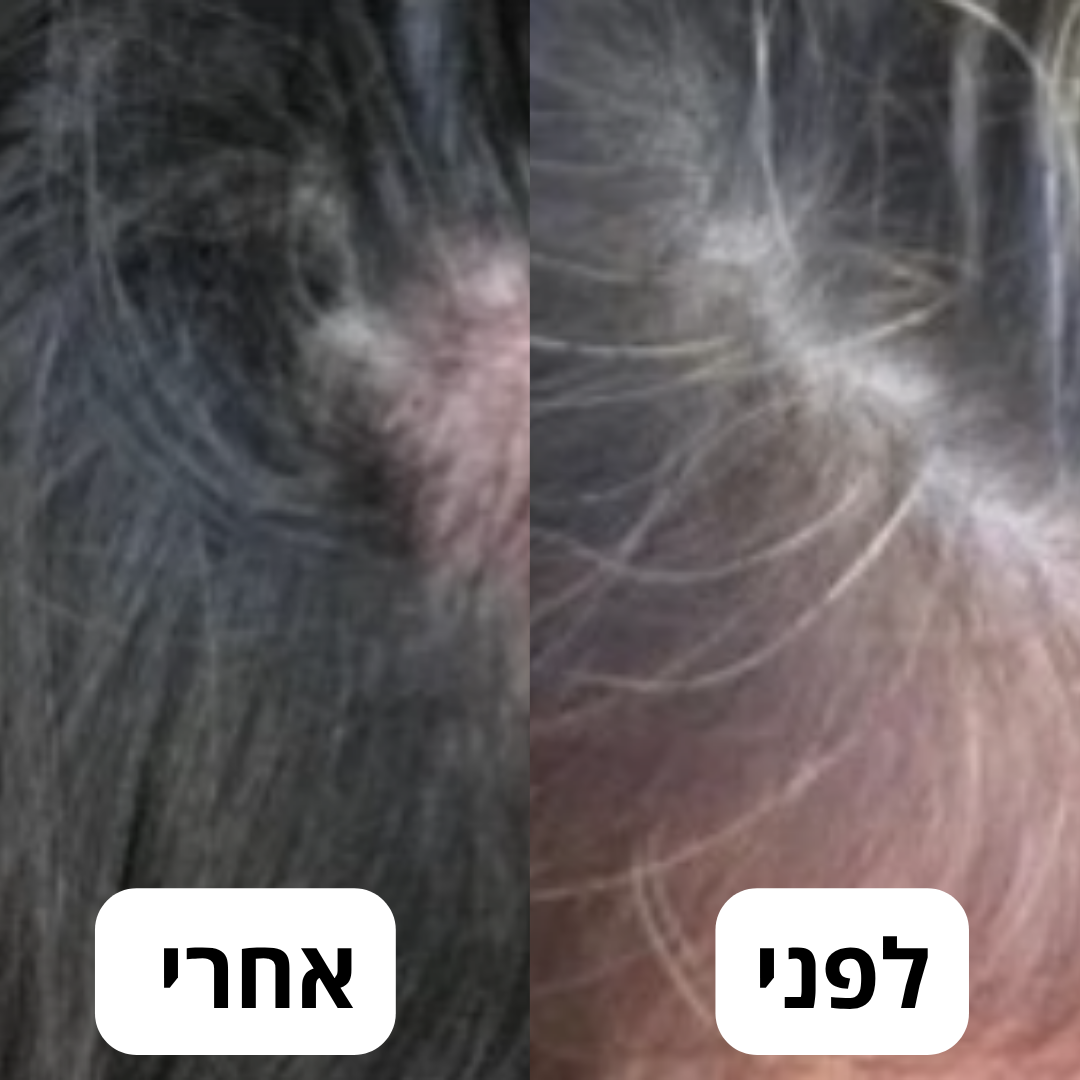 AntiGray - פתרון מתקדם לטיפול בשיער לבן