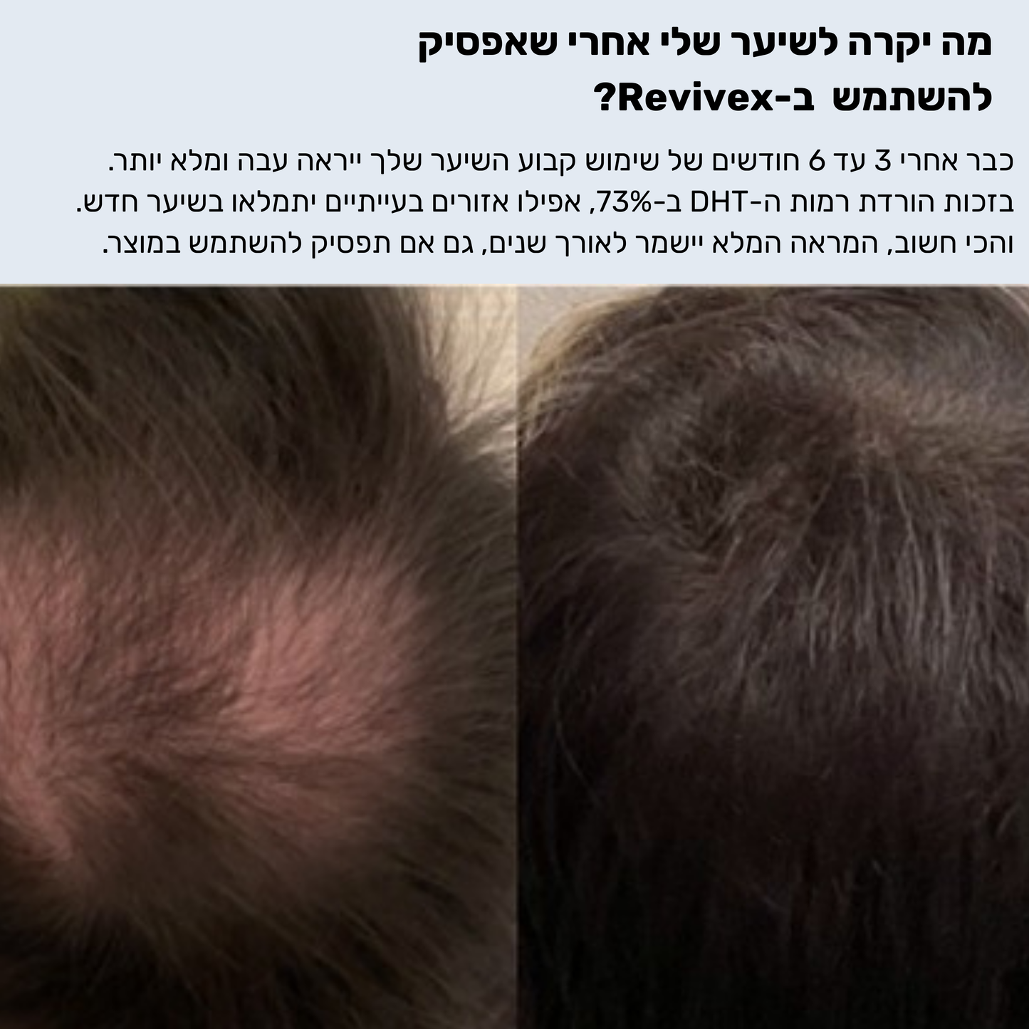 Revivex 1.0 - ערכה לטיפול ושיקום נשירת שיער והתקרחות