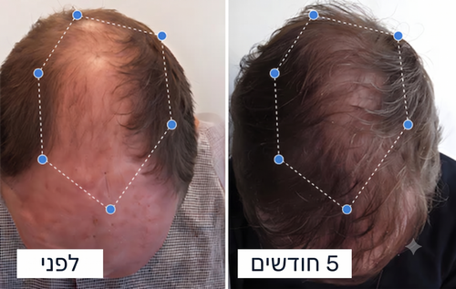 לפני ואחרי
