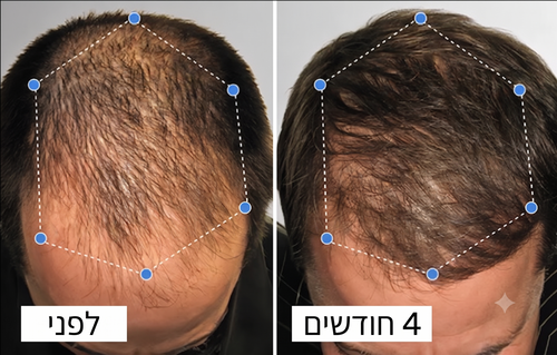 לפני ואחרי