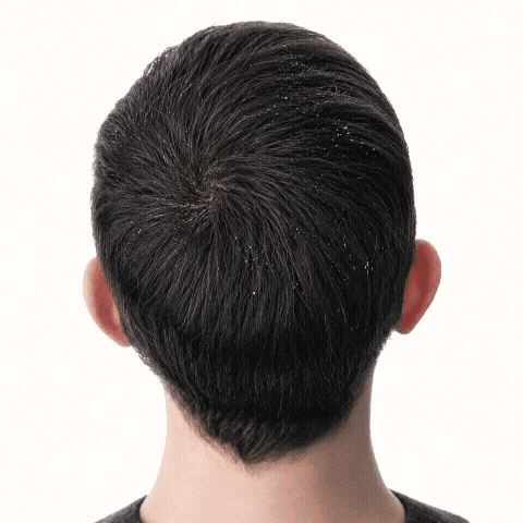 לכן לא מספיק רק לשטוף את הקשקשים שכבר הופיעו