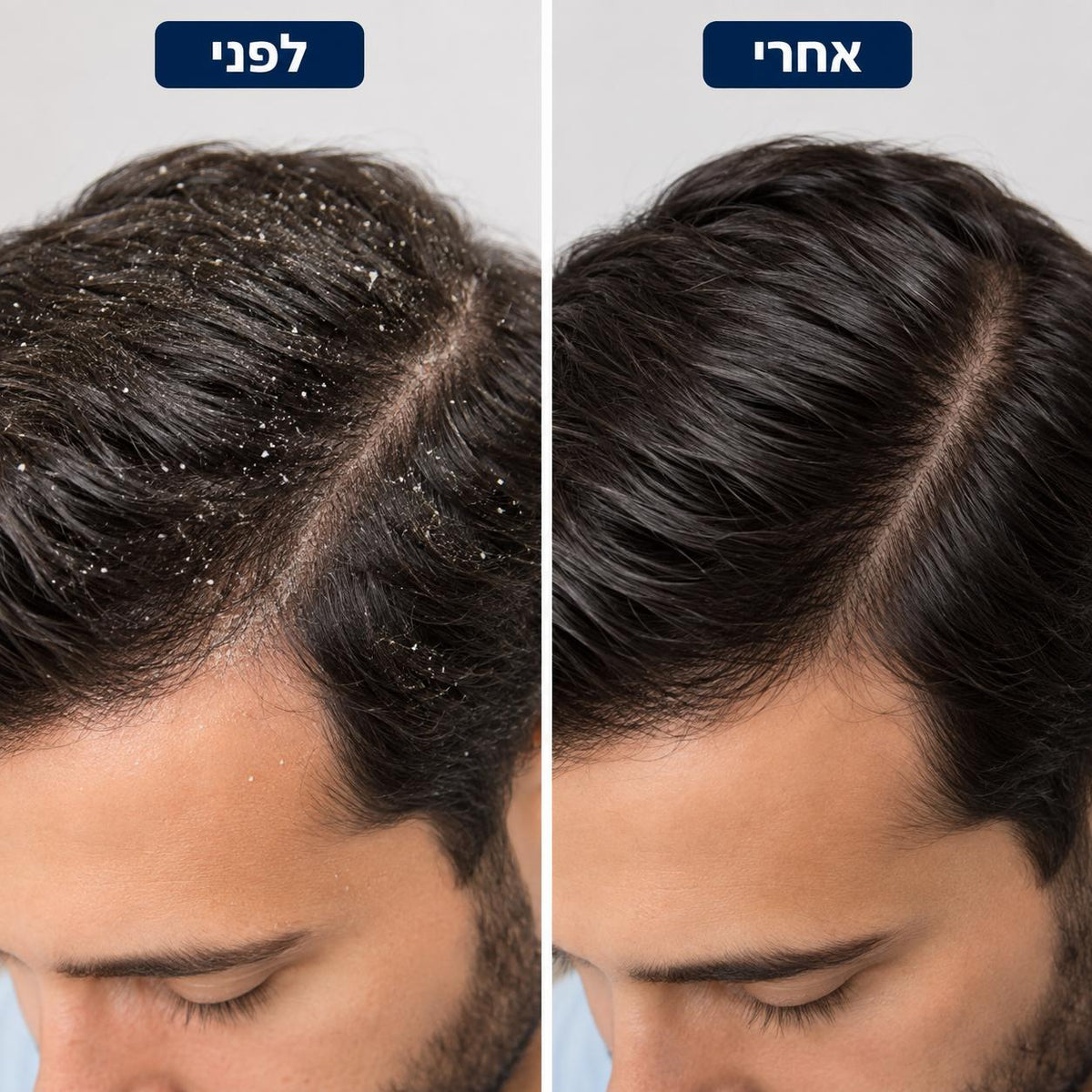 Revivex - פתרון להקלה מיידית בקשקשים גירודים ואדמומיות
